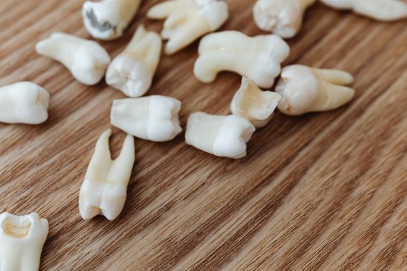 Tooth Loss and Available Solutions